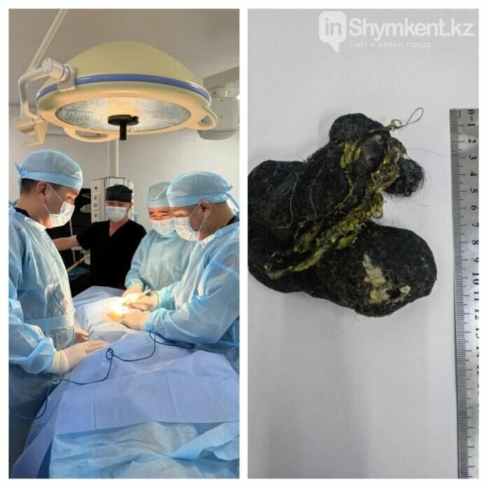 Врачи извлекли из желудка 8-летнего пациента крупный ком волос